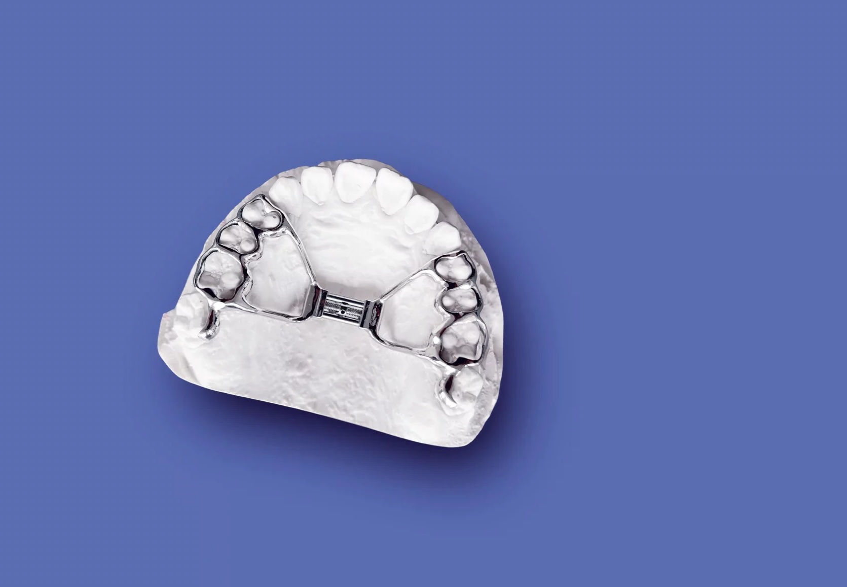 Kieferorthopaede dr alexander kuebert forabettersmile muenchen unterschleissheim leistungen gaumennahterweiterung gne scaled Kopie
