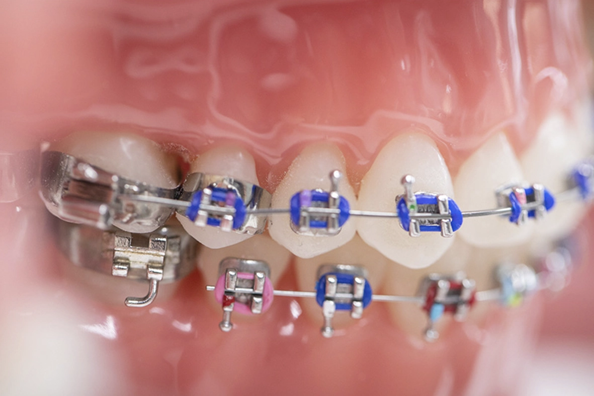 Kieferorthopaede dr david richter kressbronn am bodensee kinder jugendliche feste zahnspange metallbrackets