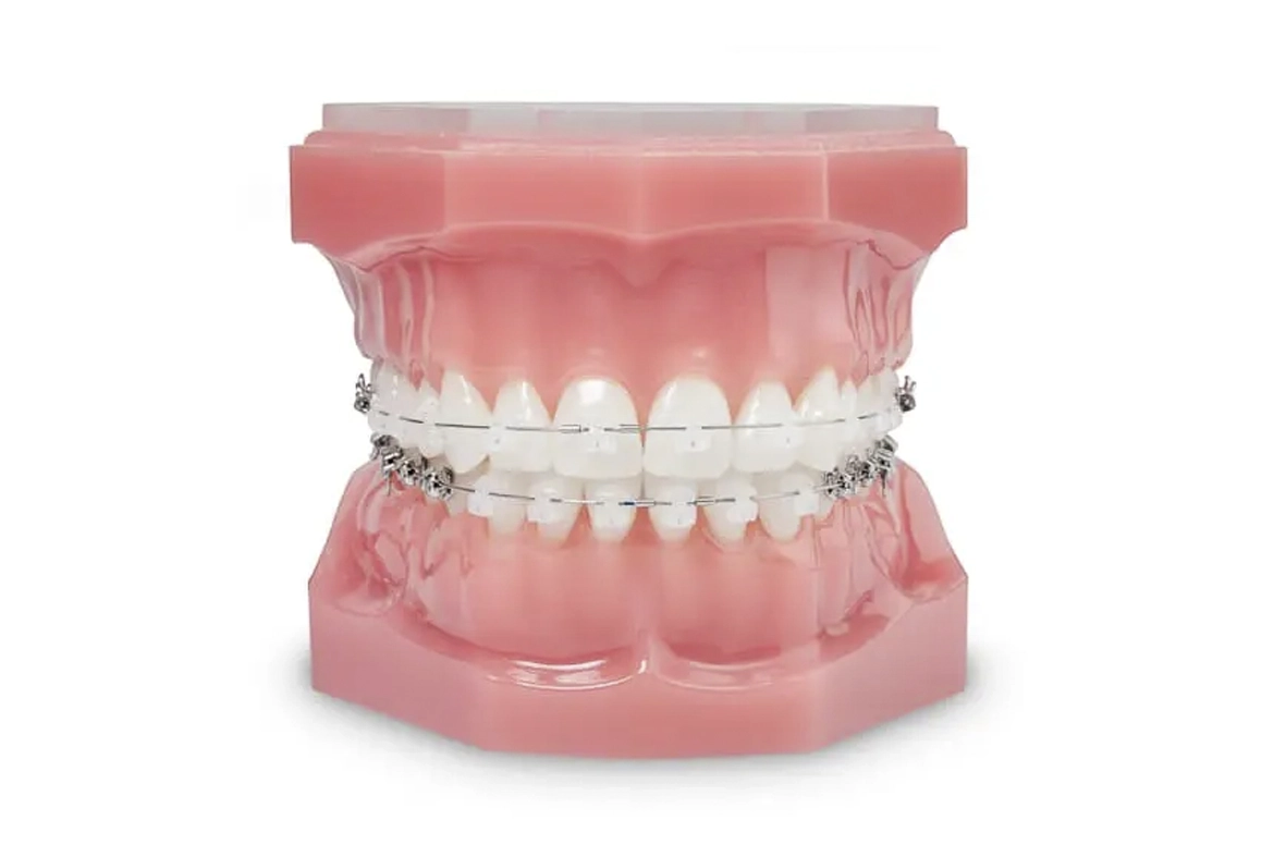 Kieferorthopaede dr david richter kressbronn am bodensee kinder jugendliche feste zahnspange selbstligierende brackets
